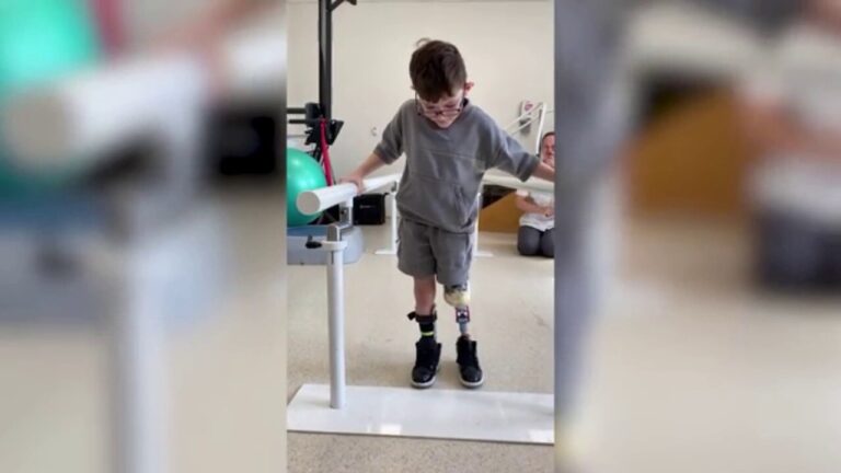 Young boy walks for the first time after leg amputation