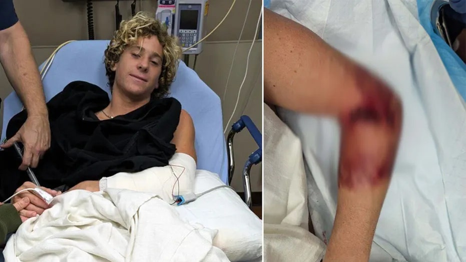 Florida teen surfer attacked by shark, says it ‘could have been so much worse’