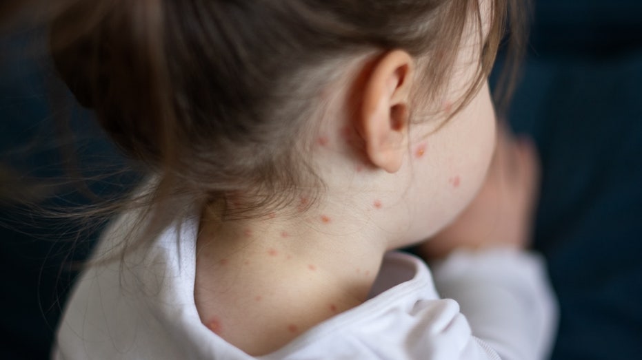 Measles cases continue to spread in multiple states following child’s death