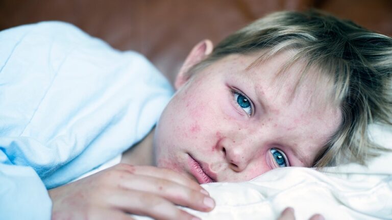 Measles outbreak continues to worsen among kids in this US state