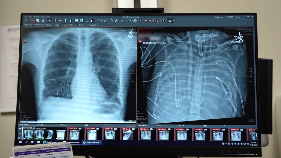 Surgeons keep man alive without lungs, paving new path to transplant