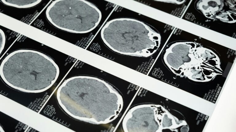 China’s ultrasound brain tech race heats up
